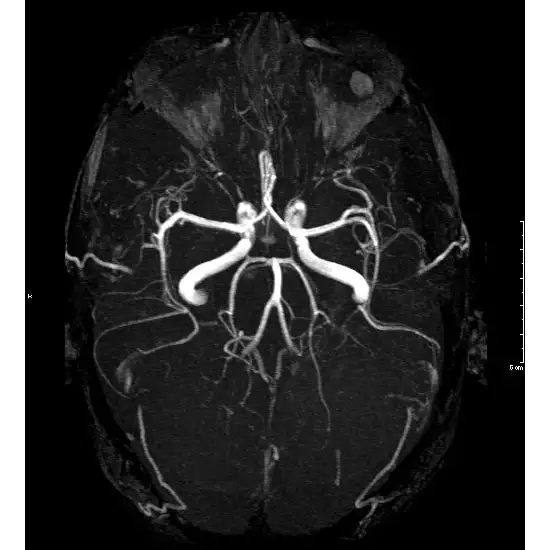 MR Angiography Brain With Contrast